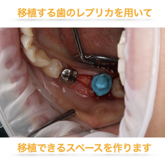 インプラントと自家歯牙移植（親知らずの移植）を併用した総合的な咬合
