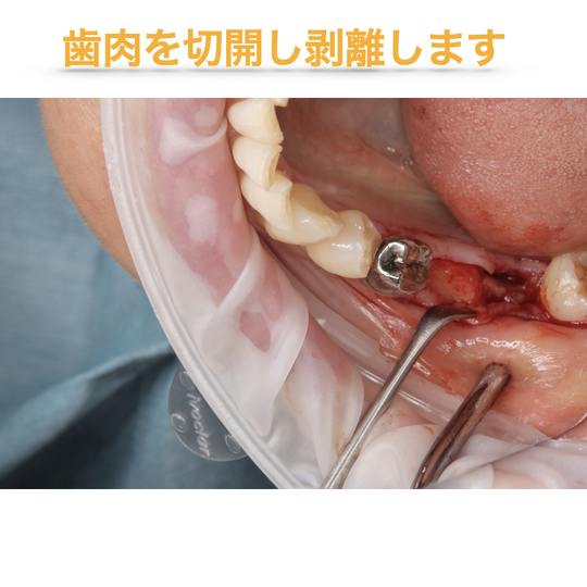 インプラントと自家歯牙移植（親知らずの移植）を併用した総合的な咬合