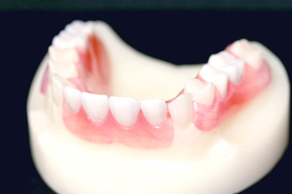 未使用 義歯・上の入れ歯① 市川市妙典で入れ歯が上手な歯医者｜噛める痛くない目立たない入れ歯！