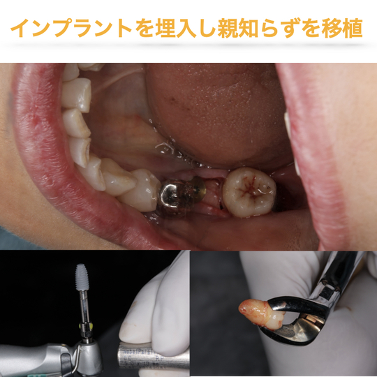 インプラントと自家歯牙移植（親知らずの移植）を併用した総合的な咬合